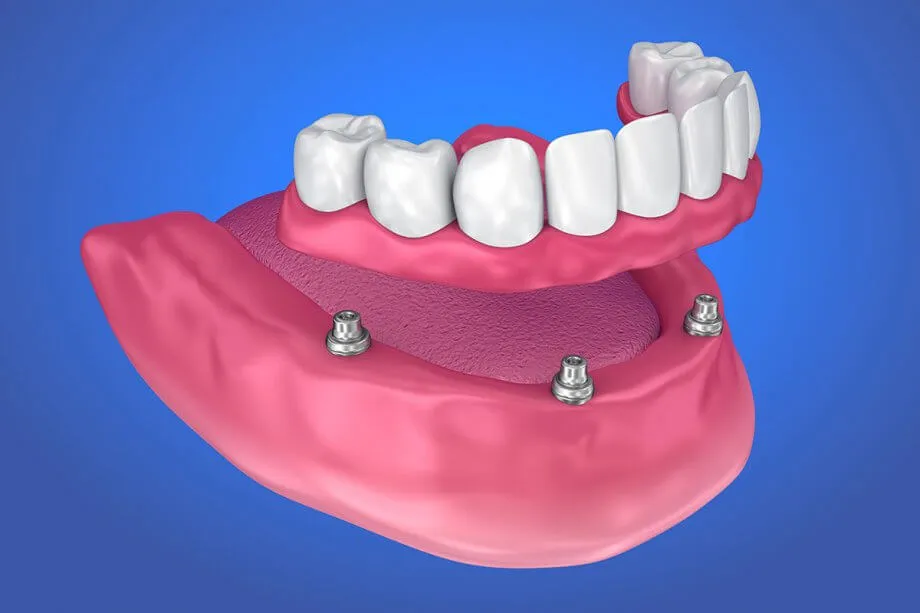 Implant Supported Dentures At Newport Beach Implant Clinic