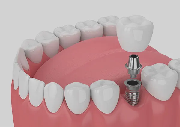 Single Tooth Implant At Newport Beach Implant Clinic