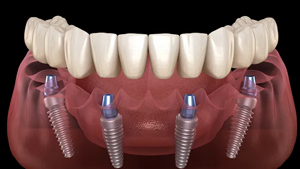 Treatment All On 4 At Newport Beach Implant Clinic