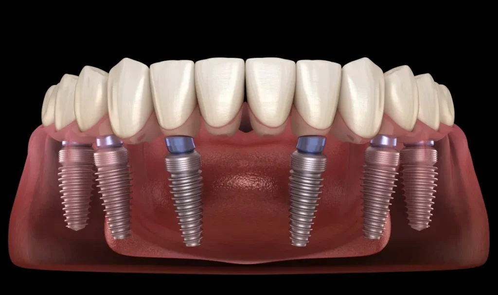 Treatment All On 6 At Newport Beach Implant Clinic