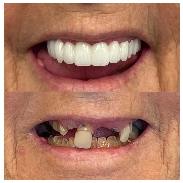 Before After Dental implants Patient At NewPort Beach Implant Clinic