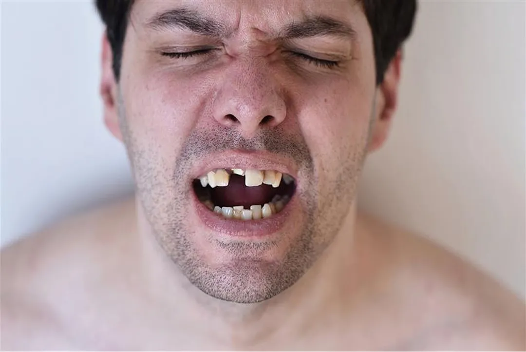 Man In Pain From Failed Dental Implants.webp